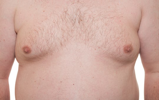 Cosmetic Breast Surgery - Gynaecomastia (male breast enlargement)