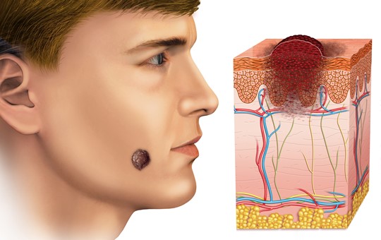 Skin Cancer Surgery - Squamous Cell Carcinoma