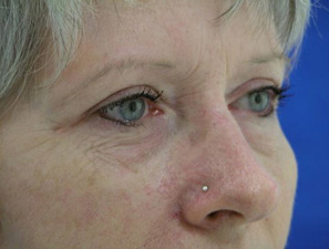 Facial Eyelid Post 3