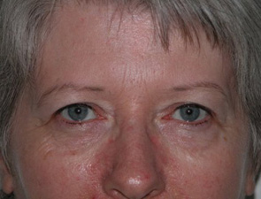 Facial Eyelid Pre 2