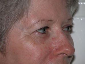Facial Eyelid Pre 3