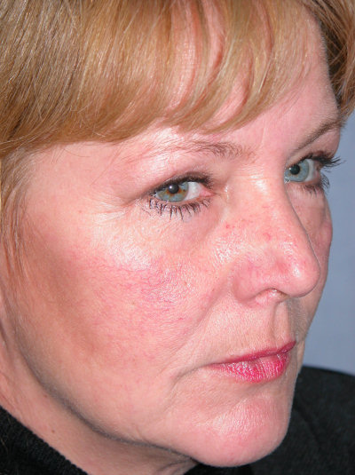 Facial Eyelid Post 1