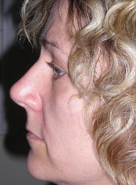 Rhinoplasty Pre 4