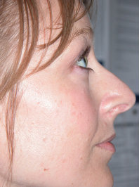 Rhinoplasty Pre 5