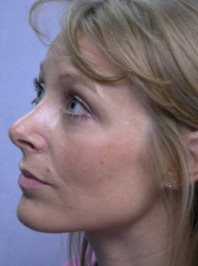Rhinoplasty Post 5