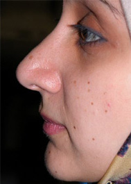 Rhinoplasty Post 8