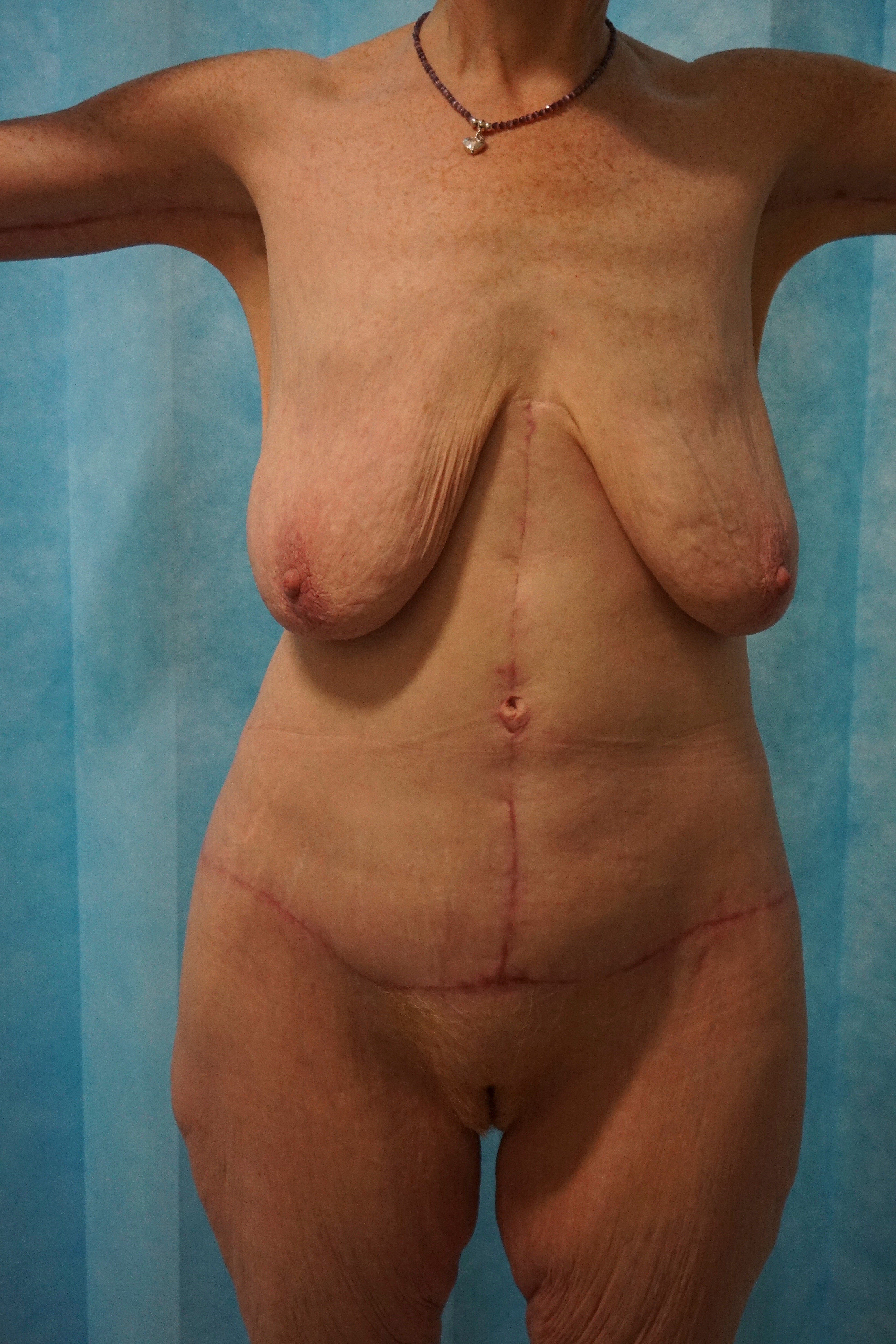 Abdominoplasty Post 19
