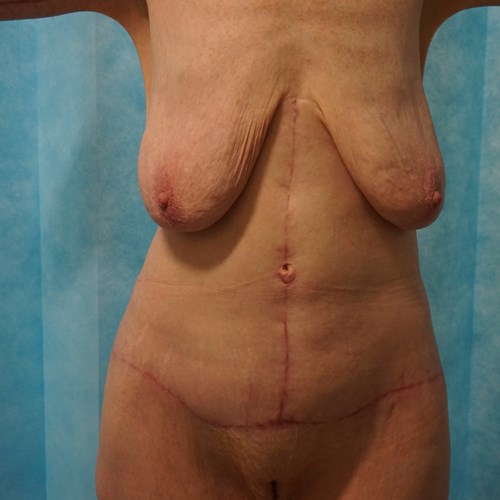 Abdominoplasty Post 19