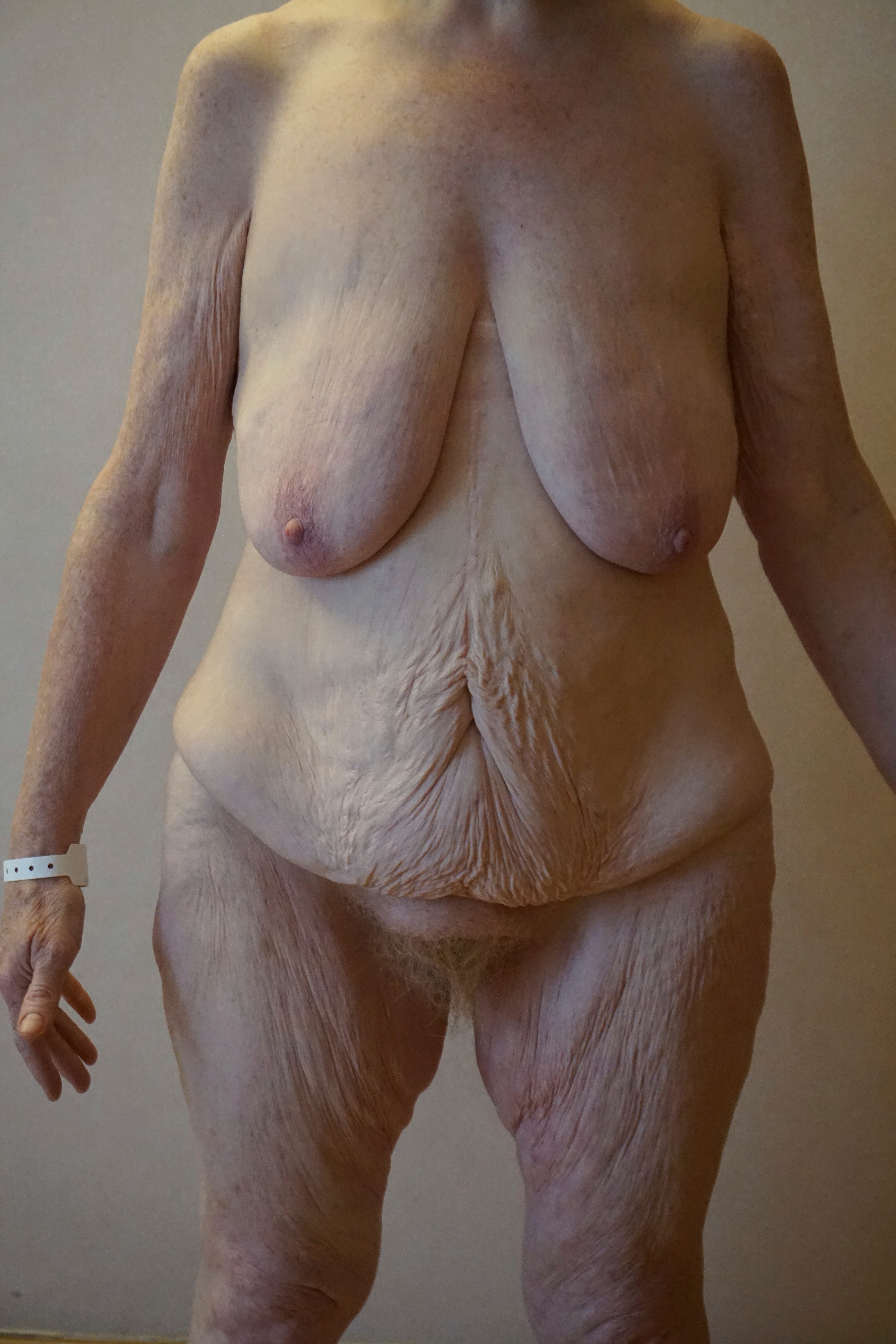 Abdominoplasty Pre 14