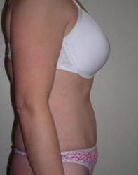 Abdominoplasty Post 1