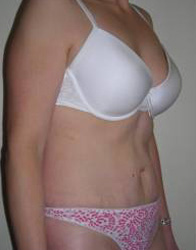 Abdominoplasty Post 2