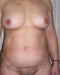 Abdominoplasty Post 3
