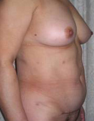 Abdominoplasty Post 4