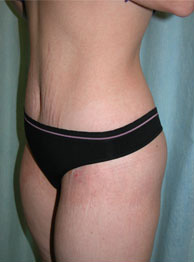 Abdominoplasty Post 7