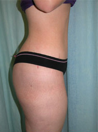 Abdominoplasty Post 8