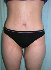 Abdominoplasty Post 9
