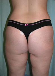 Abdominoplasty Post 10