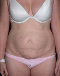 Abdominoplasty Pre 1