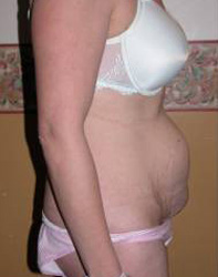 Abdominoplasty Pre 2