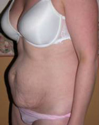 Abdominoplasty Pre 3