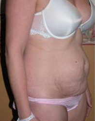 Abdominoplasty Pre 4