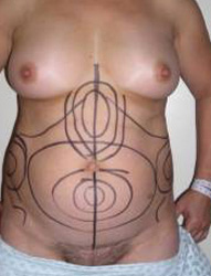 Abdominoplasty Pre 6