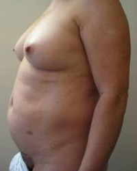 Abdominoplasty Pre 7