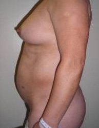 Abdominoplasty Pre 8