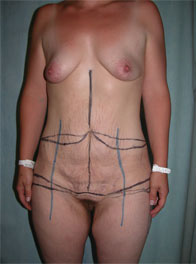 Abdominoplasty Pre 9