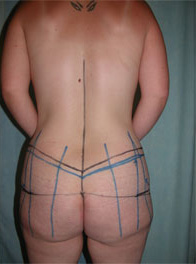 Abdominoplasty Pre 10