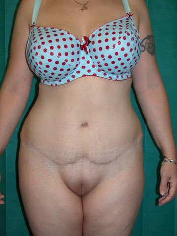 Abdominoplasty Post 16