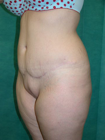 Abdominoplasty Post 17