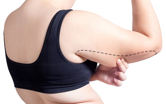 Body Contouring - Brachioplasty
