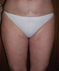 Thigh lift Post 1