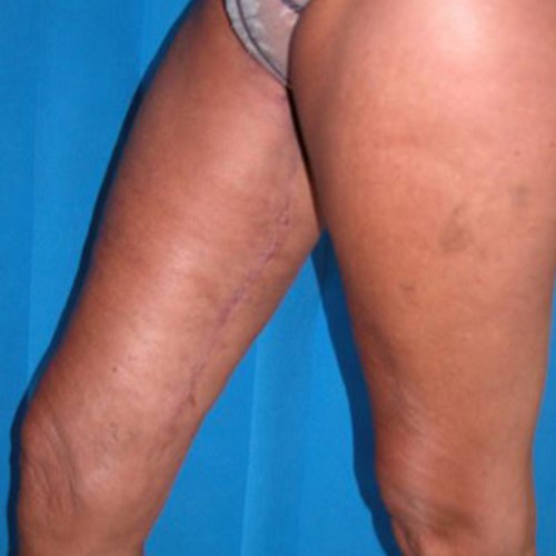 Thigh Lift Scars - How to Reduce Scarring after Thighplasty