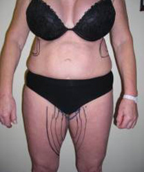 Thigh lift Pre 1