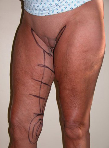Thigh lift Pre 5