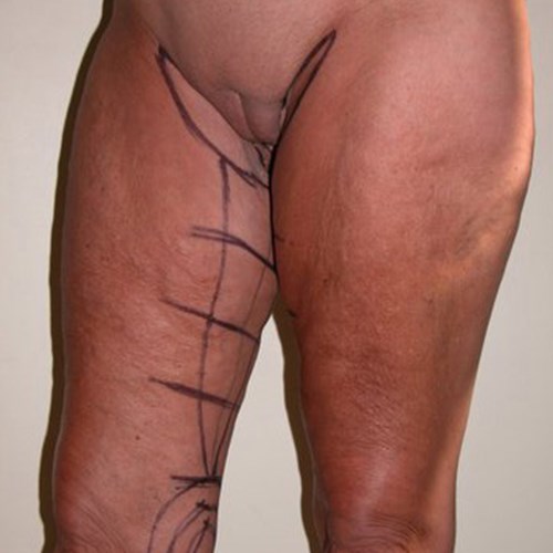 Body Contouring - Thigh Lift | Plastic Surgeon - Surrey | Mark Soldin