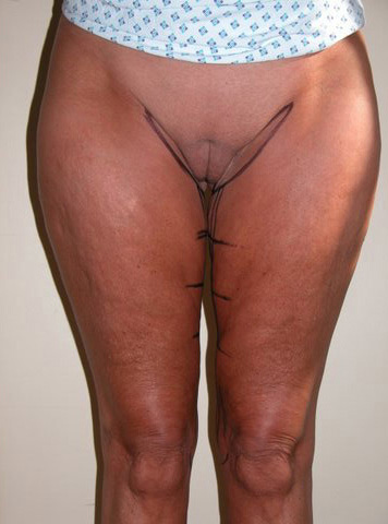 Thigh lift Pre 6