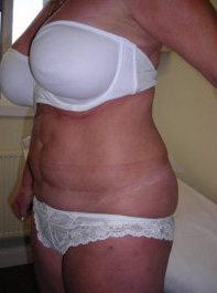 Liposuction Post 3
