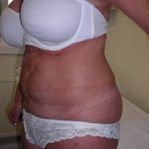 Liposuction Post 3