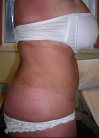 Liposuction Post 4