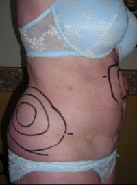 Liposuction Pre 4