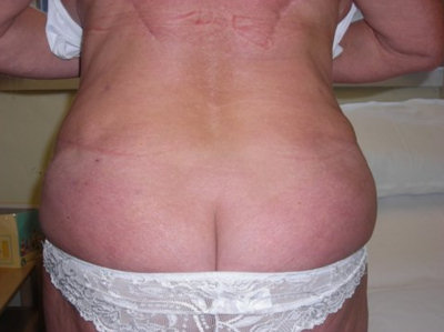 Liposuction Post 1