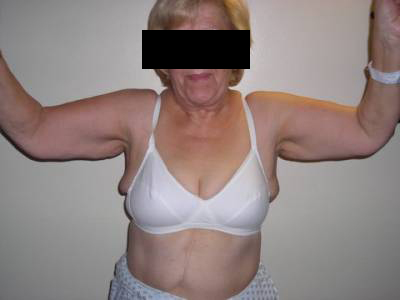 Brachioplasty Pre 2