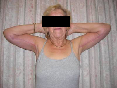 Brachioplasty Post 1