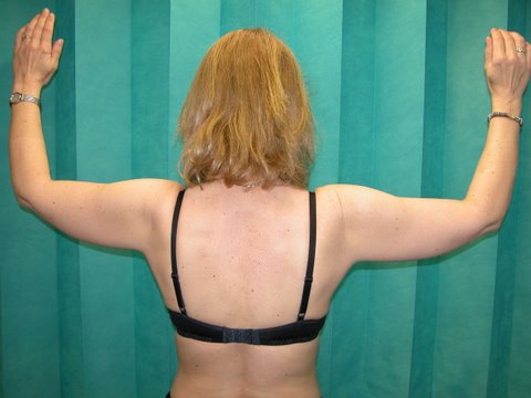 Brachioplasty Post 2