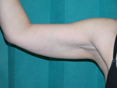 Brachioplasty Post 3