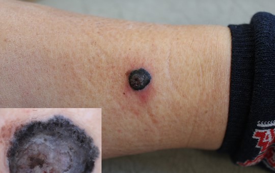 Skin Cancer Surgery - Malignant Melanoma