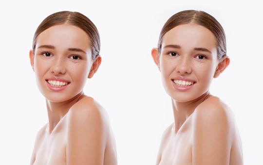 Prominent Ear Correction